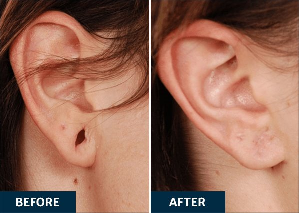 Before and After an earlobe repair