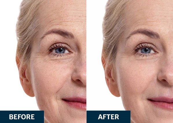 Before and after platelet-rich fibrin treatment on face